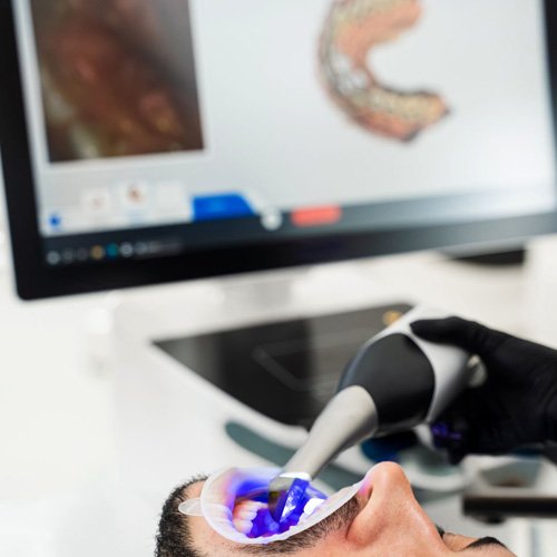 Scanner intraoral: quando vale a pena escanear no paciente?